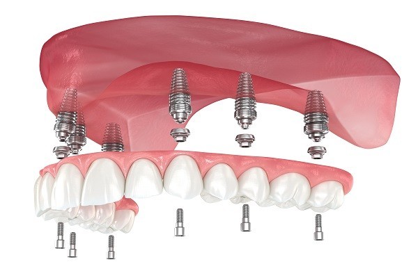 6 Tips for Cleaning Implant-Supported Dentures | Buzzy