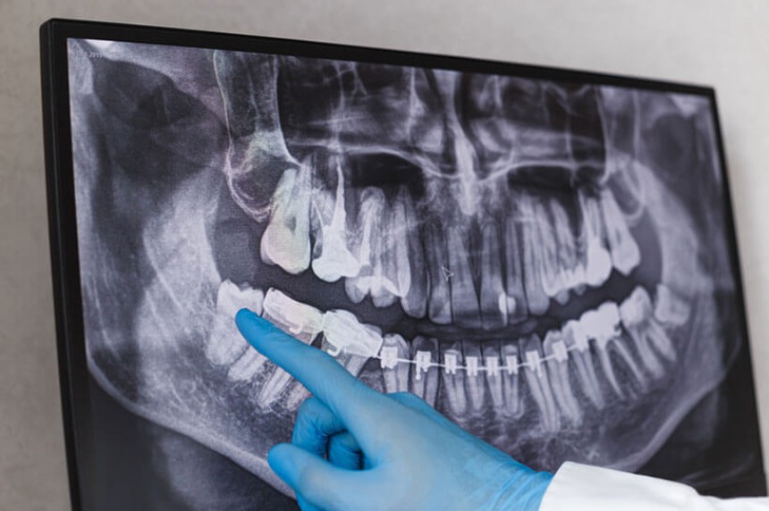 Blogs - Bang Box online - Signs Your Wisdom Teeth Are Causing Problems & Need Removal