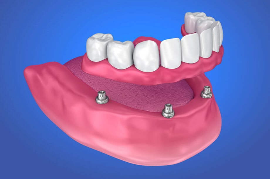 The Lifespan of Implant Dentures: How Long Can You Expect Them to Last?